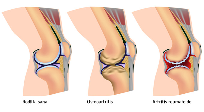 Artrosis de rodilla. Gonartrosis
